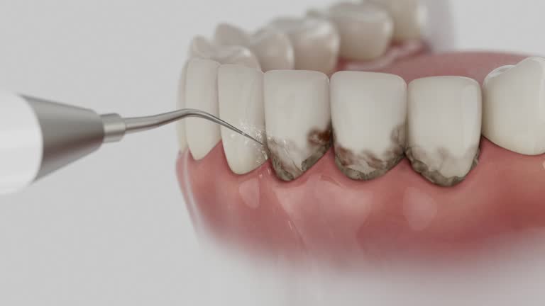 Trusted Wisdom Tooth Removal service in Sharonville, OH - Dentist Open Now